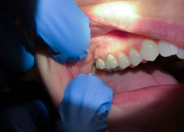 Best Broken or Chipped Tooth Repair in Victoria, MS